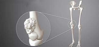 پاورپوینت تومورهای استخوانی